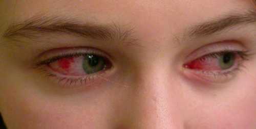 Выраженный болевой синдром не позволяет ребенку часто открывать глазки