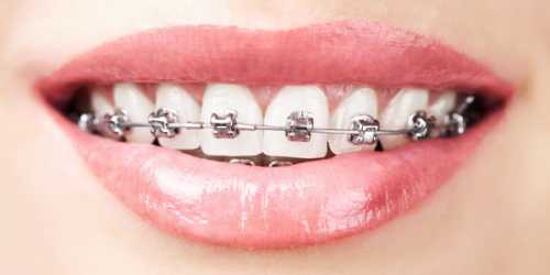 Одновременно с этим становится крайне важным исправление прикуса, ведь в противном случае повышается риск преждевременного разрушения зубной эмали изза неправильного прилегания зубов друг к другу