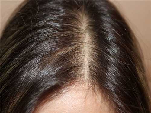 Кроме того причиной облысения может быть так называемое стягивание или натяжение волос, которое происходит в результате укладки некоторых травмирующих женских причесок, таких как коса, конский хвост и так далее