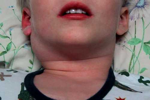 Воспаление лимфоузлов на шее у ребенка: симптомы,
