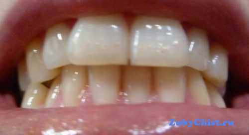 В клинической ортодонтии, а также челюстно лицевой хирургии неправильный прикус челюсти подтверждается на основе данных симметрос копии изучения формы зубных рядов с помощью электромиотонометрии определения тонуса челюстных мышц