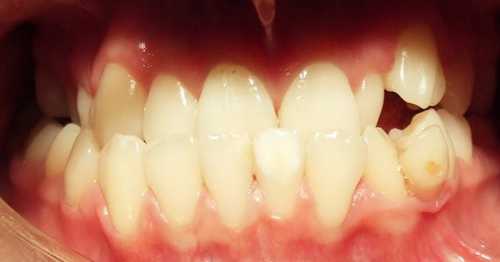 Так что стоматологпротезист непременно направит пациента со значительными нарушениями прикуса к ортодонту